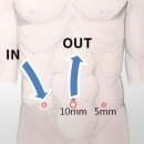 라이펙(LHIPEC)의 시술 방법 라이펙 LHIPEC/ 복막전이암 치료 이미지