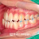 토미치과의원 | 주걱턱 치료 꼭 수술을 해야만 할까요? (타이밍을 놓친 여자 중학생의 코티코토미 치아교정 후기)