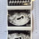 아름제일여성병원 | 임신확인부터 ~ 16주3일차 아름제일여성병원 니프티 검사 결과 아름제일조리원 구로사랑상품권 코리아...