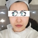 플래뉴의원 | 강남피부과_플래뉴의원 지방분해리프팅 온다 리프팅 후기