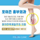 하지정맥류 한눈에 알아보기 이미지