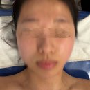 수화뷰티 | 안성 윤곽관리 화사로아뷰티 수화강리셋핏 솔직후기