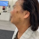 연세미엔의원 | 경주피부과 연세미의원에서 레이저토닝 흑자제거 받은후기