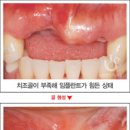 수플란트치과병원 네이버블로그
