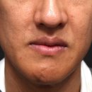 흥도초등학교 | 일산피부과 40대 리투오 후기｜스킨부스터 효과 솔직하게 말합니다