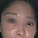 에버피부과의원 | [에버피부과] 쥬베룩 볼륨, 보톡스, 히알라제(필러녹이기)