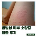 범발성 피부 소양증 탈출 후기