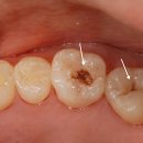 서울에이앤치과의원 | 연수구 치과 에서 알려드리는 자연치와 유사해 구분하기 힘든 크라운 수복 장점 및 관리 방법