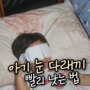 새빛안과의원 | 아기 눈 다래끼 빨리 낫는 법, 자연치유 ( 소아과 vs 안과 )