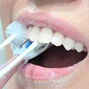 전동 | 임플란트 이식중인 사람의 쿨샤전동칫솔 솔직후기