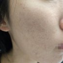 후한의원 | [수원/인계동] 혐주의! 편평사마귀 제거 전/다운타임/후 가성비 한의원 후기