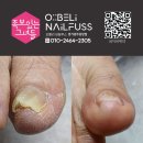 경기광주 두꺼운 무좀 내성발톱 관리 이미지