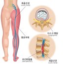 허리편한 신경외과의원 | 창원신경외과, 허리디스크 비수술적 치료 방법 2가지 알려드립니다
