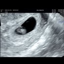 임신 초기 증상 초음파 5주차 6주차 8주차 11주차 15주차 18주차 니프티 검사 비용 후기