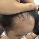리뉴미 피부과 의원 | 3살 아기 화농성 육아종 제거 수술 리뉴미 피부과 후기