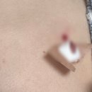 점 | 2026 부산 서면 한의원 돌출점제거 후기 튀어나온 점 제거 후기