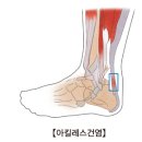 족저근막염인줄 알았는데 아킬레스건염이라구여?;; 이미지