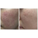 세븐일레븐(인천부평노체점) | 부평 문제성 피부전문 어반뷰티 추천 염증성 여드름 피부면역 재생케어 받은 후기