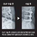 허리 통증·다리 저림 무서워 &#39;척추관협착증&#39; 수술 망설인다면… 이미지