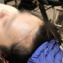 여성헤어 | 강서구 여성 헤어라인 밀도보강 후기｜비어보이는 M자탈모 스트레스 해결 👩🏻‍🦲🥊💥