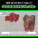 서강화농업협동조합 내가지점 | 핀란드 친구가 알려준, &#39;내려간 잇몸&#39; 차오르게 한 방법 (+6개월 후기)