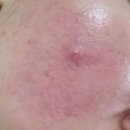 마디척한의원 | 부산주사피부염, 왜 자꾸 재발할까? (치료 전 꼭 체크해야 할 1가지)