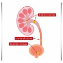문비뇨기과의원 | 쌍용동비뇨기과 요로결석 통증에서 해방되는 4단계 비밀