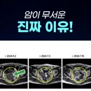 암 치료 후 2년 이내에 재발률이 가장 높은 이유 ​ 이미지