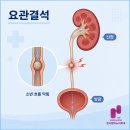 한비뇨기과의원 | 광산구 비뇨기과 전문의가 설명하는 요로결석 진단과 예방