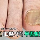 연세 많으신 고객님의 유해균발톱관리 #oddlysatisfying #toenails 이미지