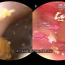 [대전 중이염 치료 한의원]진득한 농이 가득한 화농성 중이염과 맑은 액체 삼출성 중이염 [대전 월평동 한얼한의원] 이미지