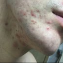 가야한의원 | 여드름흉터 이번이 마지막이라는 마음으로 찾아간 한의원 모든 회차 후기