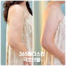 라인메디 | 365메디스킨 | 극초단파 팔라인관리 3번째 방문 후기