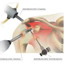 어깨회전근개파열원인, 증상, 치료법, 치료는 원데이 관절내시경으로 이미지