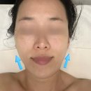 분당-97 | 수내피부관리 얼굴윤곽 받고 온 선에스테스파 분당점