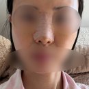 유자네면빨땡기는날 | 코실리콘제거수술-수술후기 및 경과 리얼후기