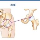 엉덩이가 아파요 고관절 통증 이유 이미지