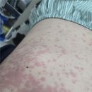 세파 | 난자체취 부작용, 전신 약물 알러지 후폭풍 후기 1 (세파알러지인가?)