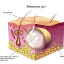 유표피낭종(Dermoid and Epidermoid Cysts of Scalp) - 서울아산병원 당일입원센터 전신마취 수술 후기