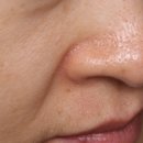 코스킨 | 광화문피부과 레디어스 후기 | 코 모공·눈밑·팔자에 효과 좋은 스킨부스터