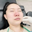 2 | 쥬베룩 스킨부스터 마블윤곽주사 슬렌코주사 2차 후기