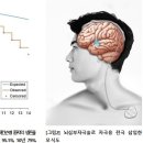 파킨슨병 뇌심부자극술, 11년 후에도 보행 가능…1년 생존율 98.8%, 5년 95.1%- 서울대병원 백선하·전범석·김한 이미지