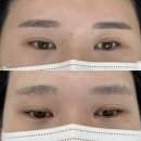 엔디씨아이 | 2년 된 눈썹문신, 피코레이저로 지워봤더니… 빨간문신제거 후기 공개