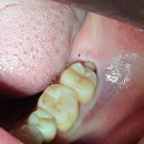 지혜산부인과의원 | [아산 연세원치과]"임신 전 사랑니 발치는 필수인가요?" 호르몬의 폭풍 속에서 어금니를 지키는 법