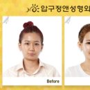 AJ성형외과 네이버블로그
