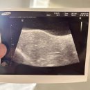 이룸여성의원 | [난임일기11] 시험관 1차 동결이식 후기 6일배아 이식 당일 기록 하단이룸여성의원