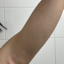 이김병원 | 미라드라이: 겨드랑이 다한증시술 통증 후기 1주차