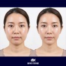 용하다한의원 | 한방스킨부스터 미주안(PN)약침