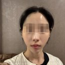 엘라비 | 잠실피부과에서 엘라비에리투오 효과 2주 후기