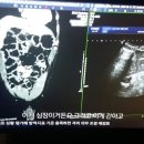 생로병사의 비밀 KBS,췌장암 재 수술 이미지